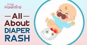 Diaper Rash in Babies – Symptoms, Causes and Remedies