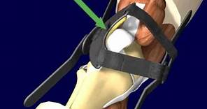 PTO (Patellar Tracking Orthosis) Knee Brace Directions and Application