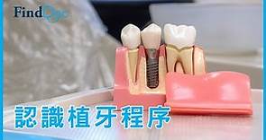 植牙要注意什麼？牙醫解構「即剝即種」技術－ 施德昌牙科專科醫生＠FindDoc.com