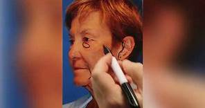 FACELIFT AND BLEPHAROPLASTY SURGERY