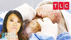Dr. Lee Treats The Largest Nasal Growths She's Ever Seen | Dr. Pimple Popper | TLC