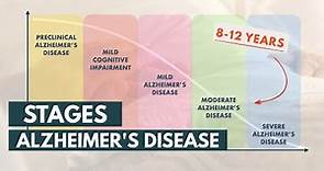 Stages and Life Expectancy of Alzheimer's Disease