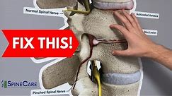 How to Fix a Bulging Disc in Your Lower Back | RELIEF IN SECONDS!