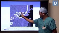 New Treatment for Superior Semicircular Canal Dehiscence - Isaac Yang, MD | UCLAMDChat