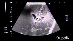 Ultrasound video left subependymal cyst in neonatal brain