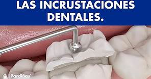 Incrustaciones dentales - Restauración de muelas ©