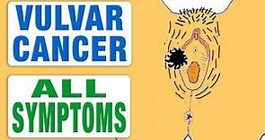 Vulvar Cancer - All Symptoms