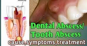 Dental Abscess: Cause, Symptoms, Treatment & Prevention | Periapical abscess | Periodontal abscess