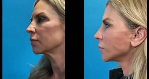 Advanced Facelift Dynamic Photos from Advanced Facelift Before & Afters