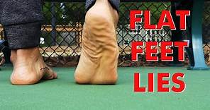 Fixing Flat Feet is a Lie?!