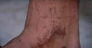 Dak Prescott's Gnarly Ankle Surgery Scars Revealed In 'Hard Knocks' Opener