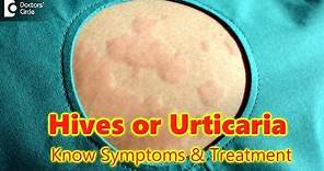 Hives | Urticaria-Causes,Symptoms,Treatment | Skin Rash | Allergy - Dr.Rasya Dixit | Doctors' Circle