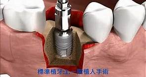 人工植牙(標準三階段植牙術) 道明/安民/澄正 牙醫診所