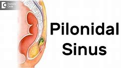 What is Pilonidal Sinus? Symptoms, Diagnosis, Treatment - Dr. Rajasekhar M R
