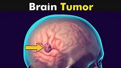 What Happens in Brain Tumor? | Symptoms and Causes (3D Animation)
