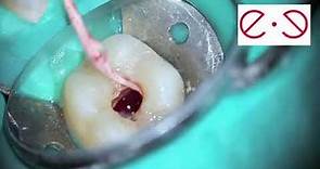 Utilización del Microdebrider para la extracción de un nervio palatino en un primer molar superior