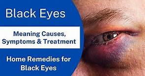 Black Eye: Causes, Symptoms, Prevention, and Treatment | Home Remedies for Black Eyes