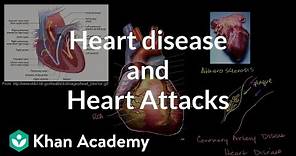 Heart disease and heart attacks | Miscellaneous | Heatlh & Medicine | Khan Academy