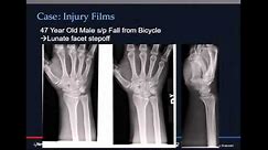 Comminuted intraarticular distal radius fractures - when to fix, span, or close reduce