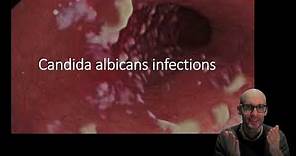 Candida albicans infections