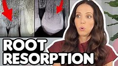 What Is Root Resorption?! (Short Tooth Roots Explained)