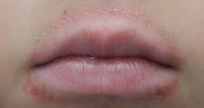 Causes and Treatments for a Rash Around the Mouth (With Pictures)