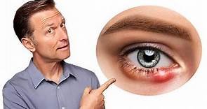 針眼的真正原因，如何快速消針眼？自然療法,柏格醫生 Dr Berg