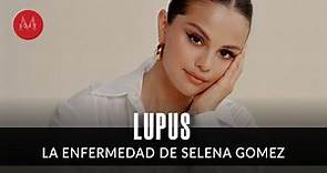 Lupus: Qué es y cómo identificar la enfermedad que tiene Selena Gomez