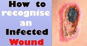 How to recognize an Infected Wound