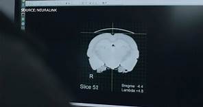 Musk’s Neuralink: First Patient Receives Brain Implant