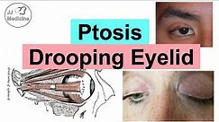 Ptosis (Drooping Eyelid) | Eye Anatomy, Causes, Associated Conditions, Diagnosis & Treatment