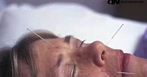 Agopuntura, gli aghi della salute