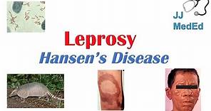 Leprosy (Hansen's disease) | Who is at risk, Signs and Symptoms, Diagnosis, and Treatment