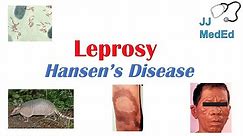 Leprosy (Hansen's disease) | Who is at risk, Signs and Symptoms, Diagnosis, and Treatment