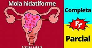 Mola hidatiforme 🤰| Completa y Parcial (Incompleta) | Diagnóstico diferencial y Tratamiento