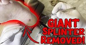 Splinter Removal: Watch as We Extract a Massive Splinter from a Patient's Heel!