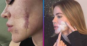 Khloé Kardashian Reveals Just How Scary Her Skin Cancer Situation Was