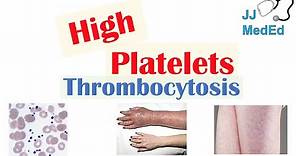 What Causes High Platelets (Thrombocytosis) | Approach to Causes, Symptoms, Treatment