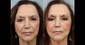 Female Blepharoplasty Before and After by Dr Edwin Williams