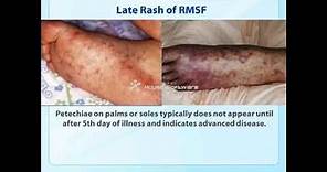 Rocky Mountain spotted fever (RMSF) Clinical Training