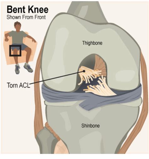 download ACL Injury and Its Treatment