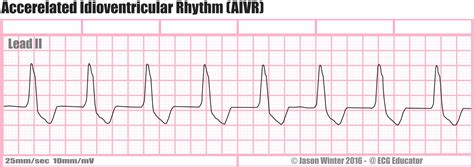 Idioventricular Rhythm Rate