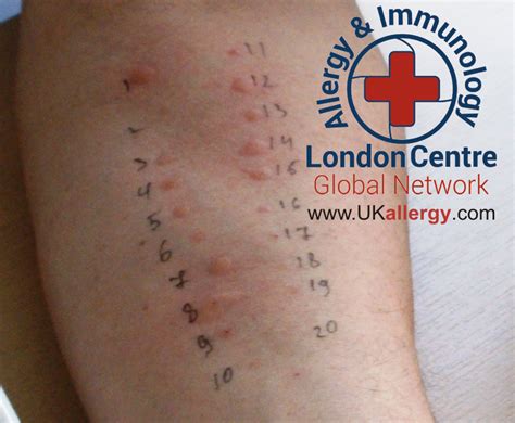 Allergy London, Private Allergy Clinic