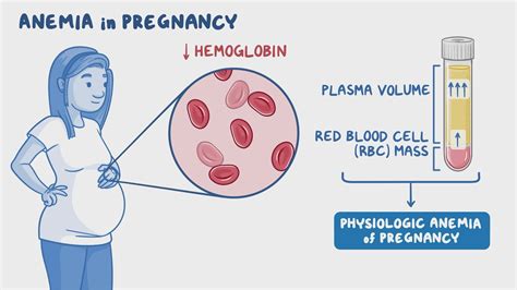 Anemia during pregnancy
