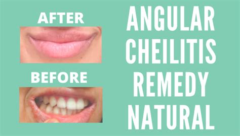 Angular Cheilitis Treatment Mouth
