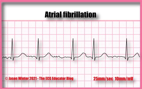 Atrial Flutter ECG