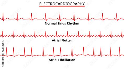 Atrial Flutter EKG
