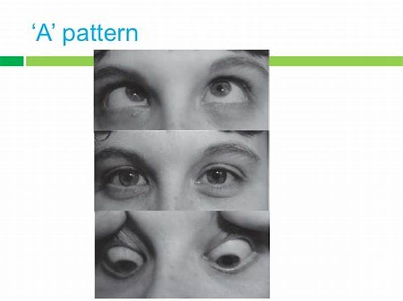 Av Pattern Strabismus