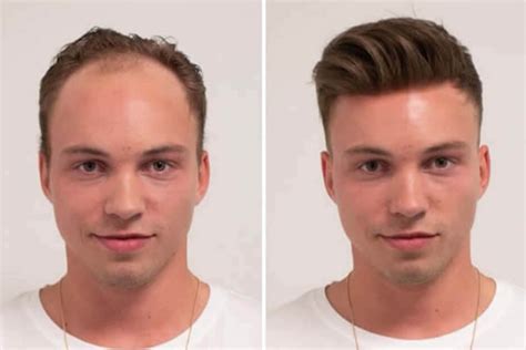 BLENDED HAIR REPLACEMENT FOR MEN BY ICENI