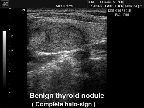 Benign Thyroid